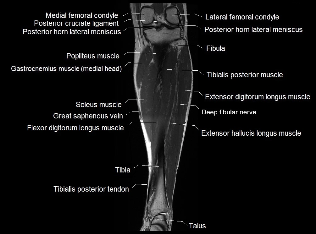 MRI 3T leg (tibia & fibula) labelled coronal cross sectional anatomy image 16.webp